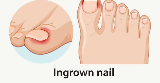 Ingrown Toe Nail and Nail Surgery image